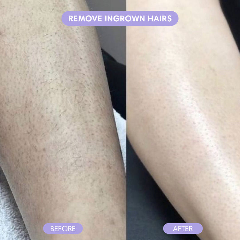 NEW: 🏆 2025 RATED HAIR REMOVAL INNOVATION